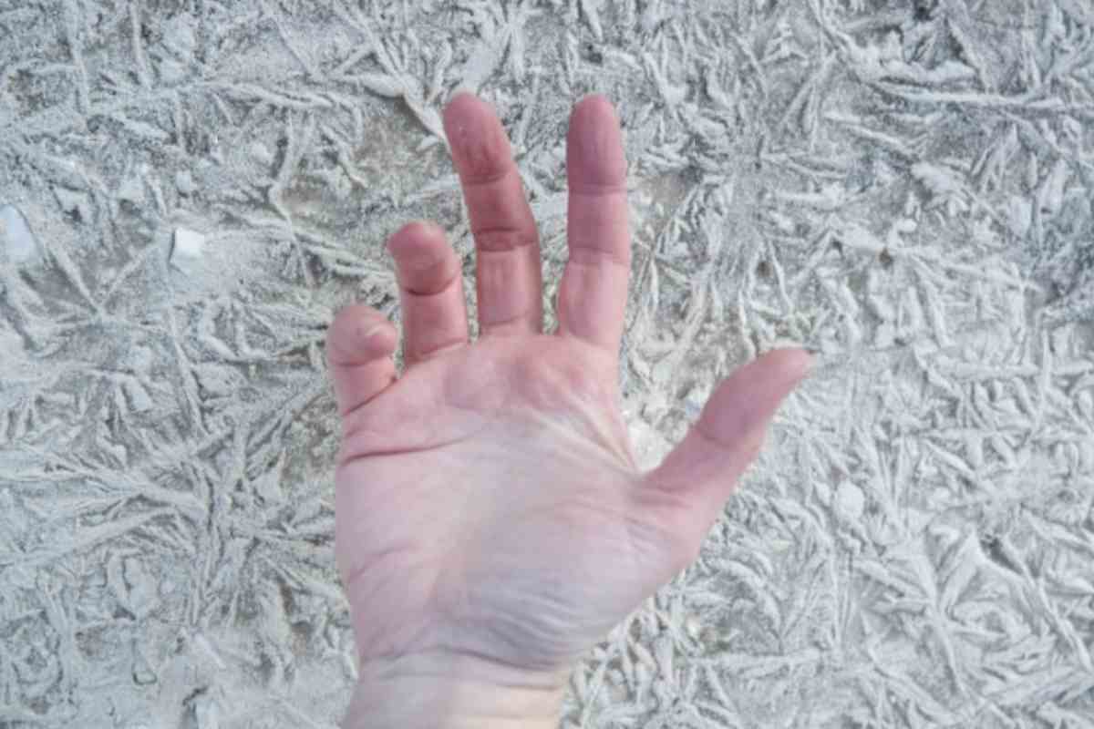 Le ustioni da ghiaccio vengono classificate in tre o quattro gradi in base alla gravità del danno. Dalle forme superficiali