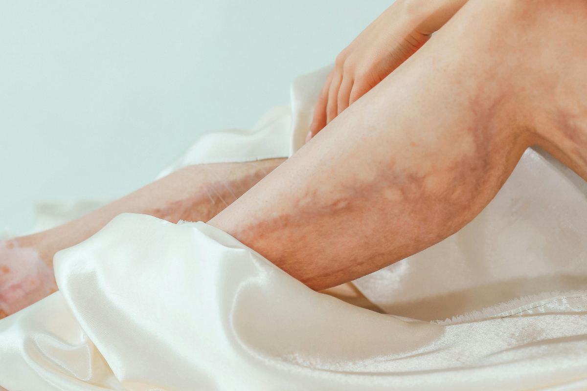 capillari fragili come fare